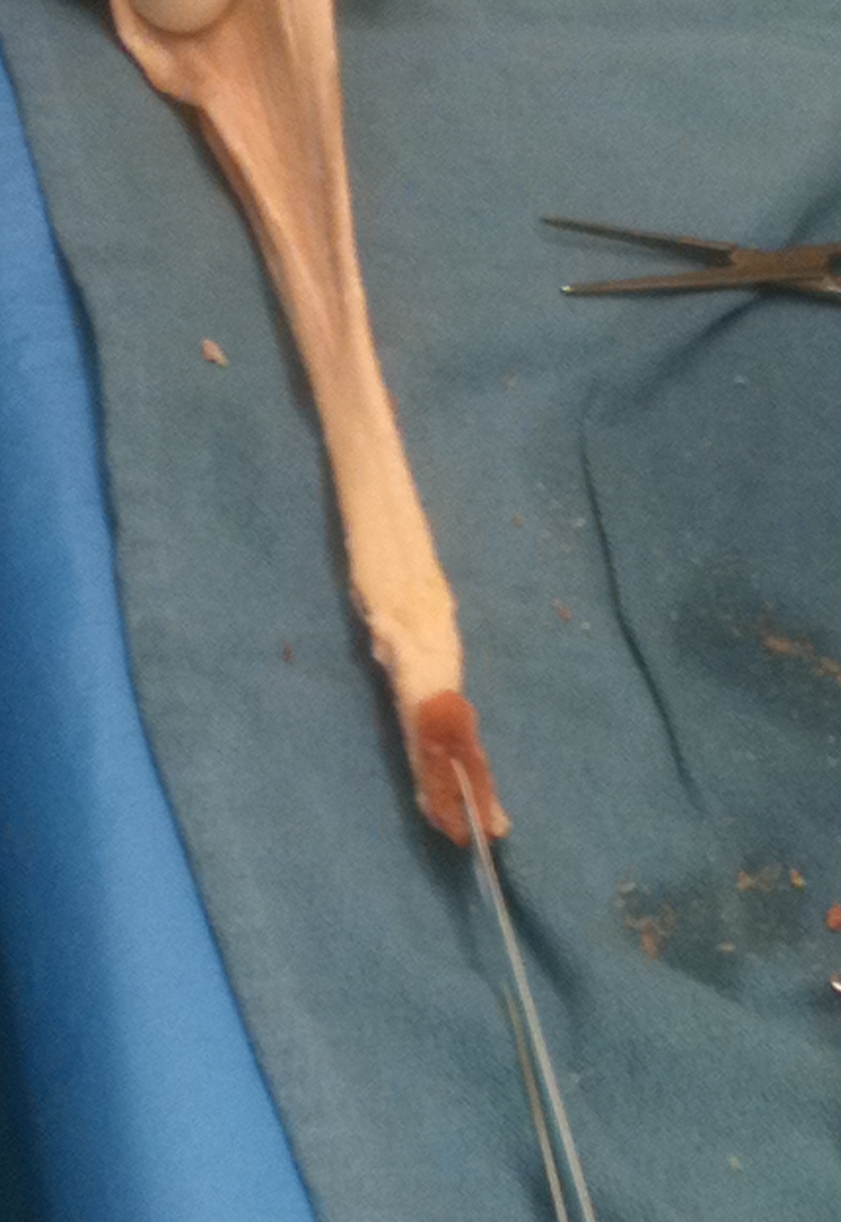 Achilles Tendon Allograft Final